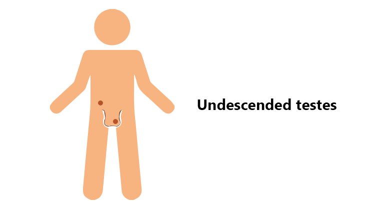 undescended