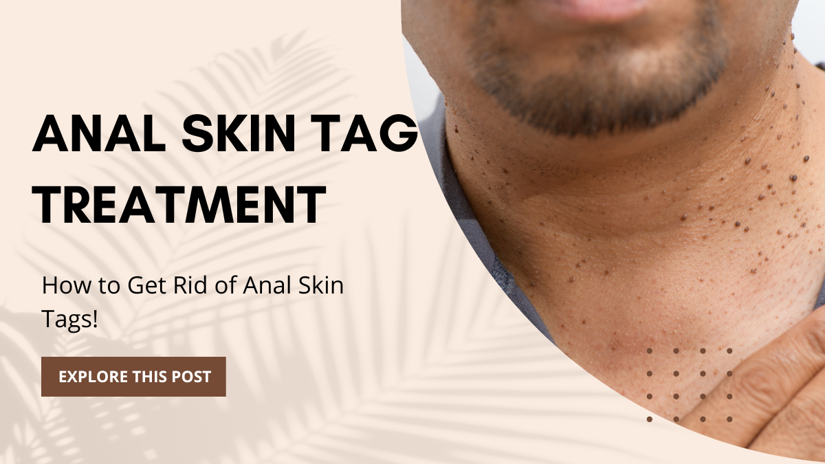 How To Get Rid Of Anal Skin Tags